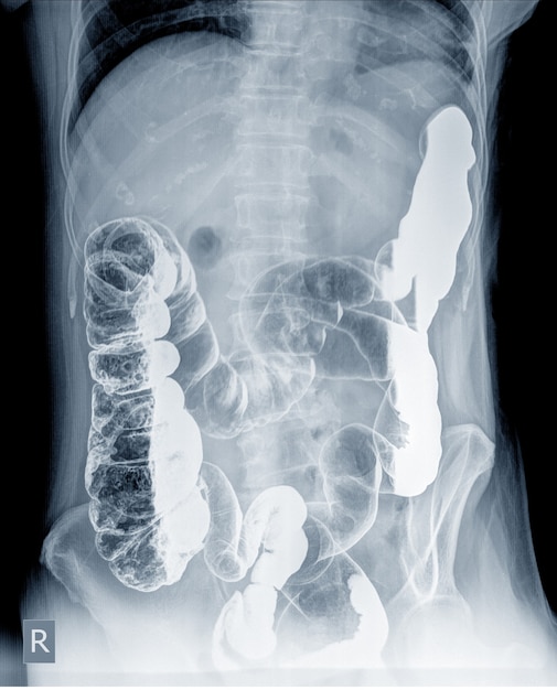 Radiological examination to look for colon abnormalities By enema the barium powder and air into the anus. Then x-ray was done. Medical image concept.