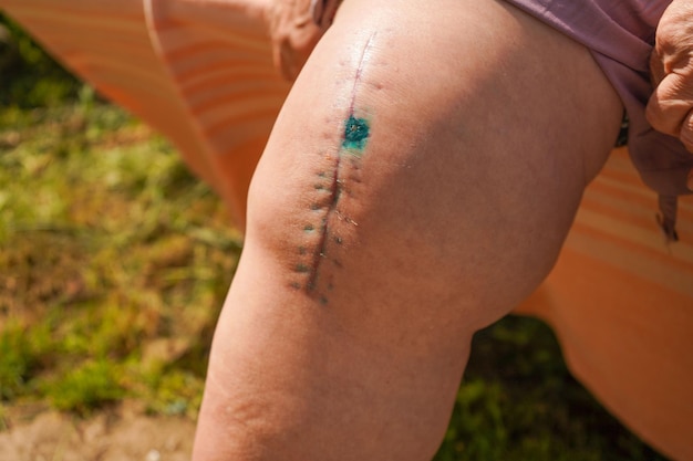 Photo recovery and wound healing on the human body scar from operation postoperative suture on the male leg