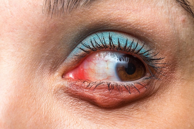 Red eye with chalazion visible redness and stye