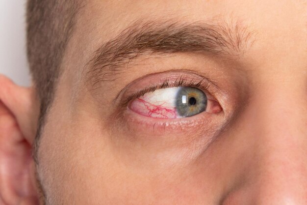 Photo red male eye with damaged blood vessels closeup retinal diseases after injury inflammation