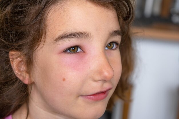 Photo a red swollen eyelid on a child face in closeup is an allergy to an insect bite allergic reaction to bloodsucking insects