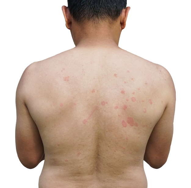 Ring Worm infection on back body  Dermatophytosis on skin Dermatitis on the skin of a mans back