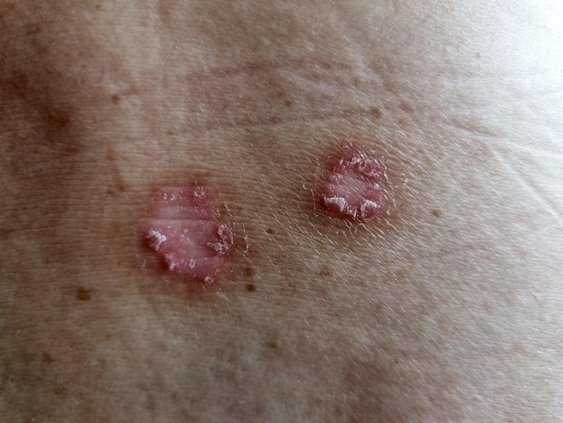 Ringworm Tinea Corporis on a human back Dermatophytosis