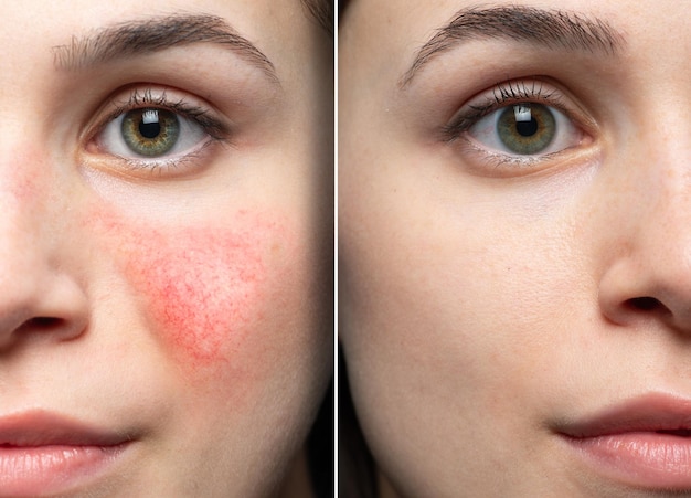 Rosacea before and after the cosmetic treatment of skin disorders