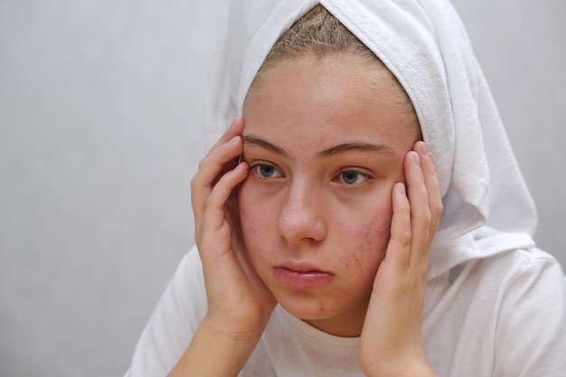 Photo a sad teenage girl is looking at the pimples on her face in the mirror. problematic skin in adolescents. acne. skin care concept