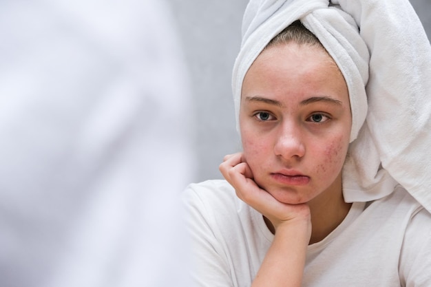 A sad teenage girl Problematic skin in adolescents Acne