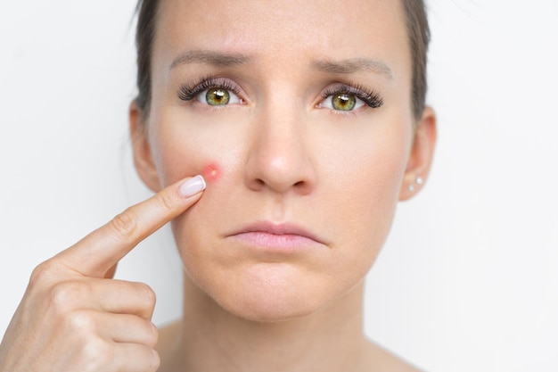 Sad woman face with pimple on her cheek