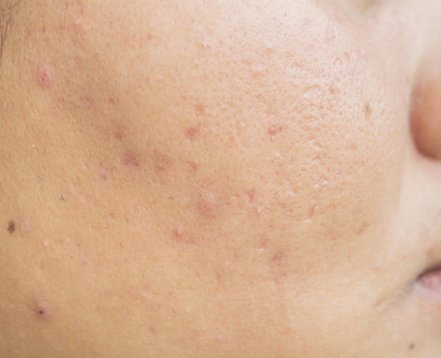 Scar from Acne on face  and Skin problems and pores in teenagers