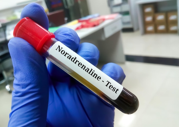 Scientist hold blood sample for Noradrenaline hormone test