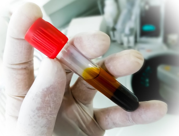 Scientist hold test tube with icteric serum for test in laboratory. Hyperbilirubinemia.