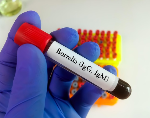 Scientist holding blood sample tube for Borrelia IgG and IgM test, Lyme disease diagnosis.