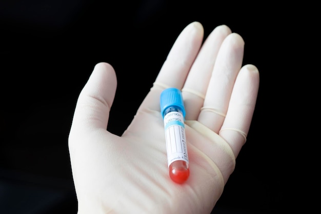 Scientist holding test tube of blood sample on black background closeup with space for text empty white label for the patient 's name or blood test result Virus research