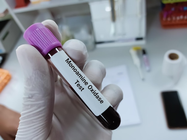 Scientist holds blood sample for Monoamine oxidase (MAO) test.