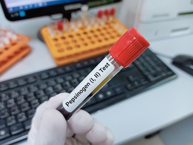 Scientist holds blood sample for Pepsinogen (I,II) test, diagnosis for early detection of gastric.