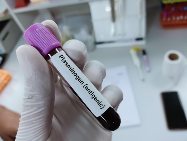 Scientist holds blood sample for  Plasminogen (antigenic) test.