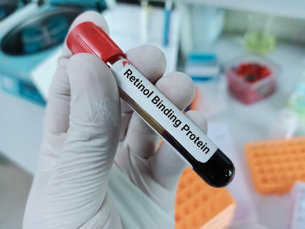 Scientist holds blood sample for Retinol Binding Protein testing.