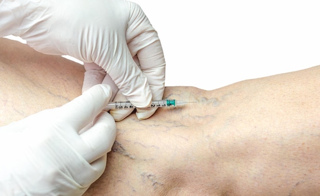 Sclerotherapy male man Removal varicose veins injection syringe Atrophied veins Telangiectasias