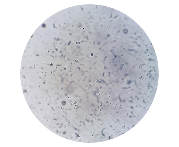 Semen analysis under microscopy showing Pyospermia or Leukocytospermia. Sperm analysis.