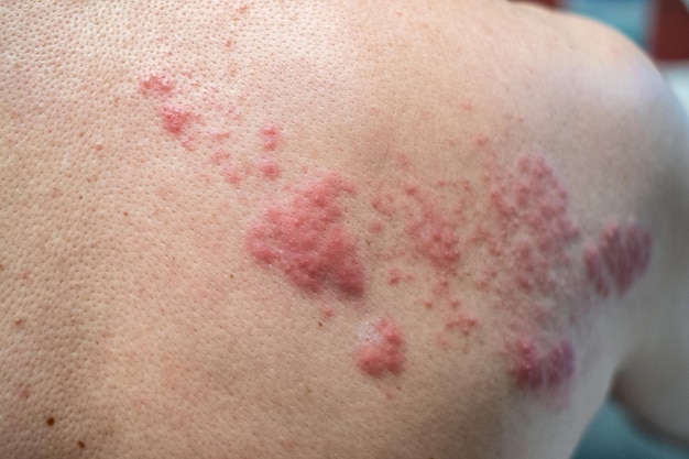 Shingles Disease Herpes zoster varicellazoster virus skin rash and blisters on body