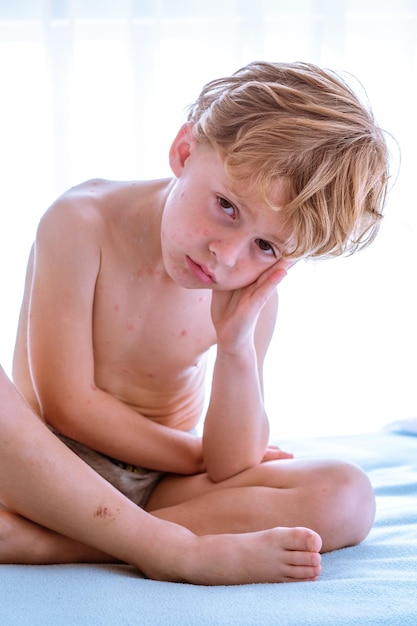 Shirtless barefoot boy with varicella blisters leaning on hand and looking at camera while sitting cross legged on bed in daytime