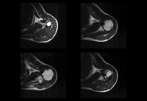 Shoulder ct scan and MRI unique and professional images