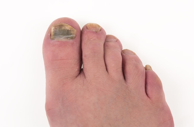 Sick nail on the leg fungus on the big toe