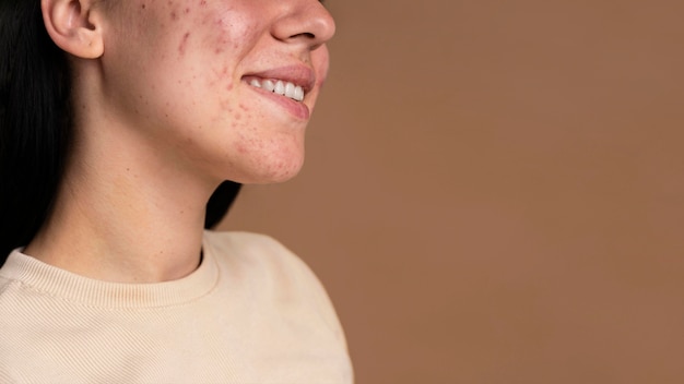 Side view young woman with acne