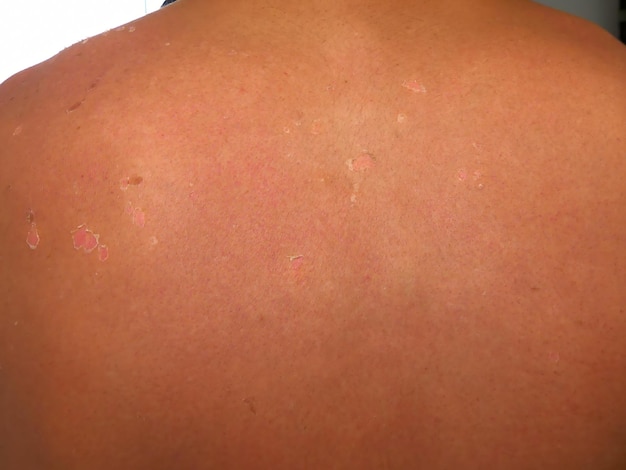 Significant epithelial erythema after long sun exposure