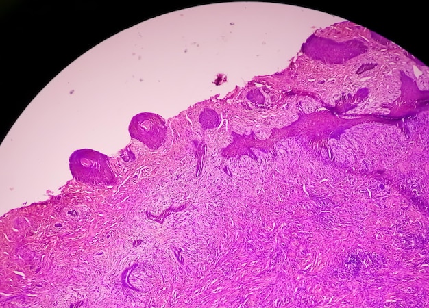 Skin biopsy under microscopy suggestive of basal cell carcinoma, the most common type of skin cancer