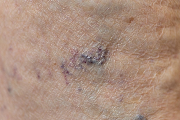 skin of an elderly person with varicose veins