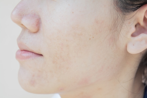 Skin problems and dark spots. scar from Acne on face