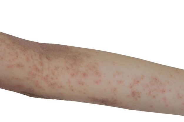 Photo skin rash on the arms isolated a white background