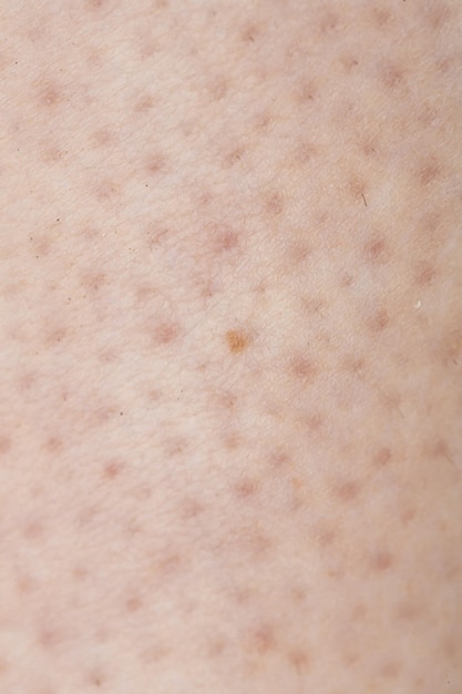 Photo skin showing folliculitis inflammation epidermis dermatology allergy