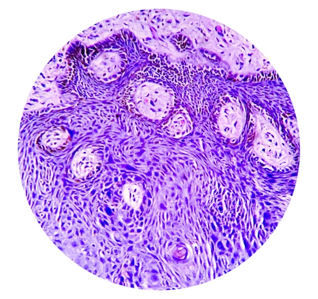 Skin tissue biopsy Lichen planus. show skin tissue, hyperplastic squamous epithelium cell. histology