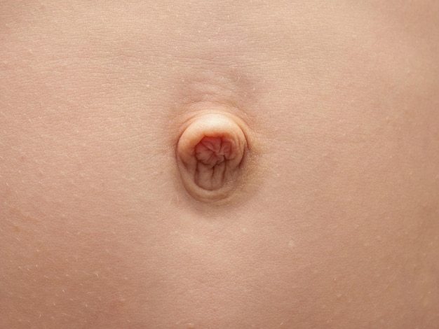 Small umbilical hernia belly button of a 9 year old boy