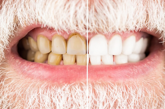 Smiling man before and after teeth whitening procedure closeup Closeup Of A Smiling man Teeth Before And After Whitening Male teeth before and after whitening oral care dentistry stomatology