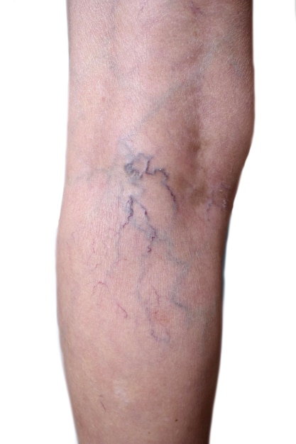 Southeast Asian Myanmar old woman's leg Skin creases loosen and thin skin and varicose veins show aging