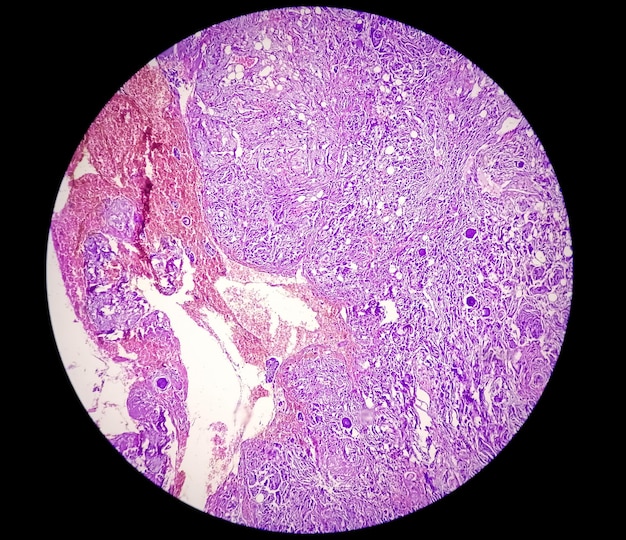 Spinal tumor biopsy showing Psammomatous meningioma. Psammoma bodies.