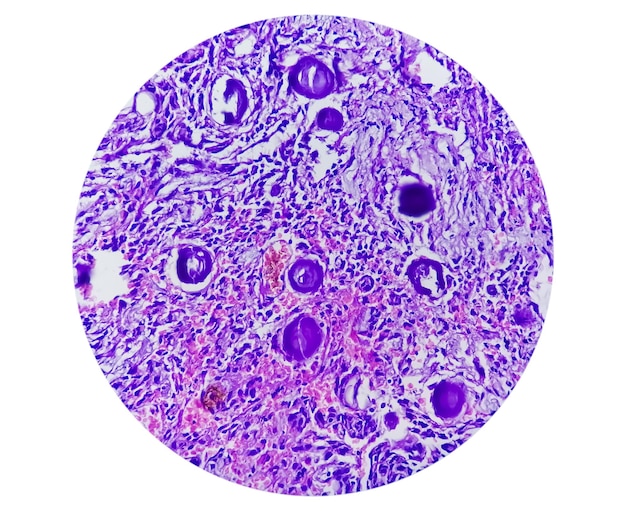 Spinal tumor biopsy showing Psammomatous meningioma. Psammoma bodies.