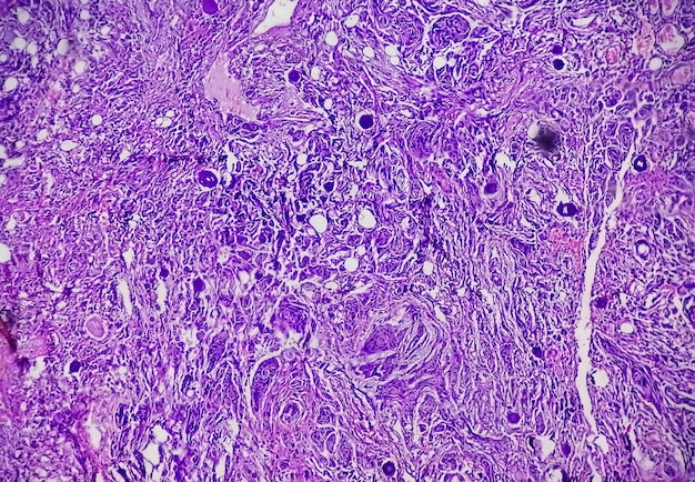 Spinal tumor biopsy showing Psammomatous meningioma. Psammoma bodies.