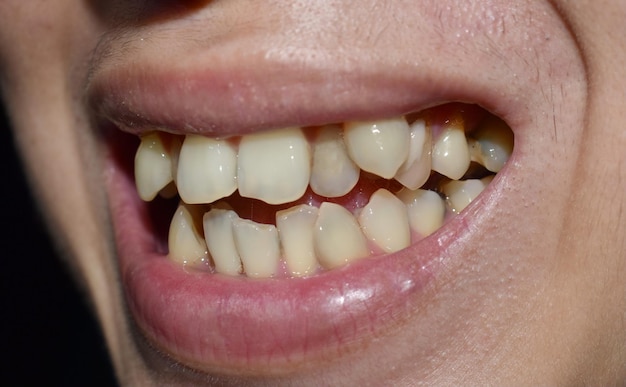 Stacked or impacted teeth of Asian man Also called crowded tooth