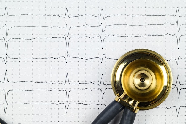 A stethoscope and a recorded electrocardiogram with supraventricular extrasystoles lie on a table in a cardiologist39s office