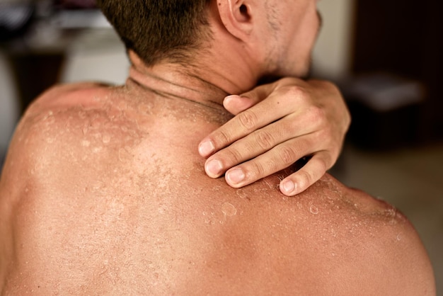 Sunburn concept skin peeling on man's shoulders touches with his hand