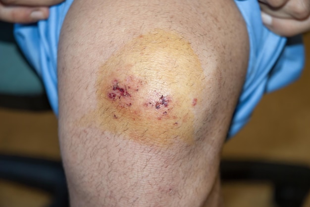 Superficial skin erosions in the knee resulting from a fall