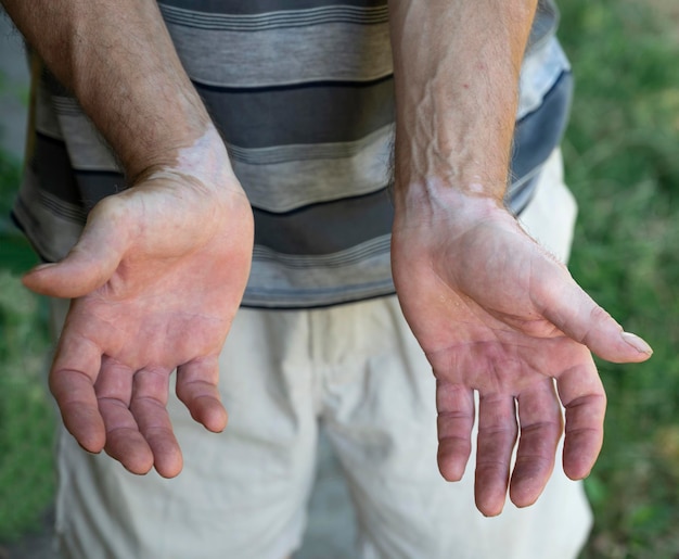 Symptoms of vitiligo on the skin on the hands of a man