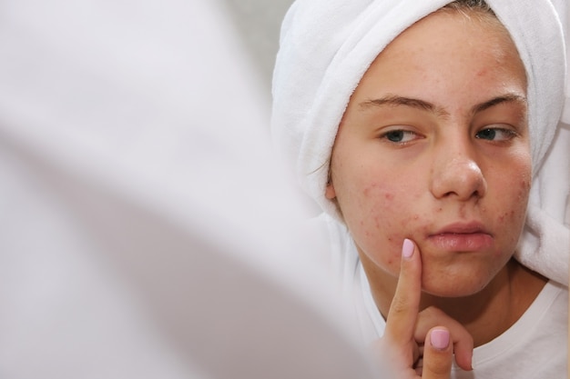 A teenage girl in a white towel on her head is looking at her face with problem skin in the mirror. Acne.