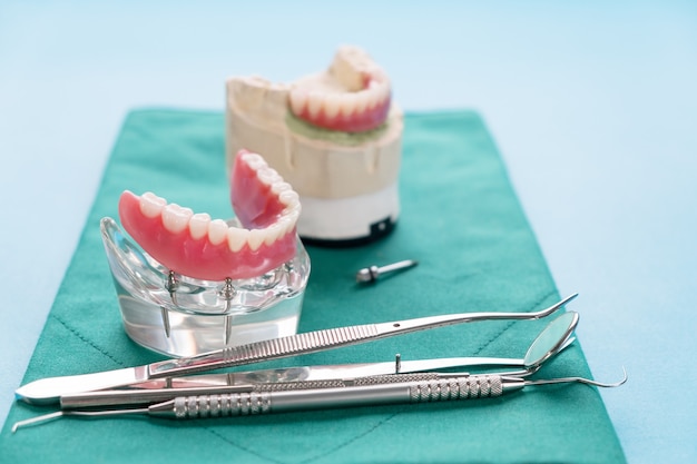 Teeth model showing an implant crown bridge model/ dental demonstration teeth study teach model.