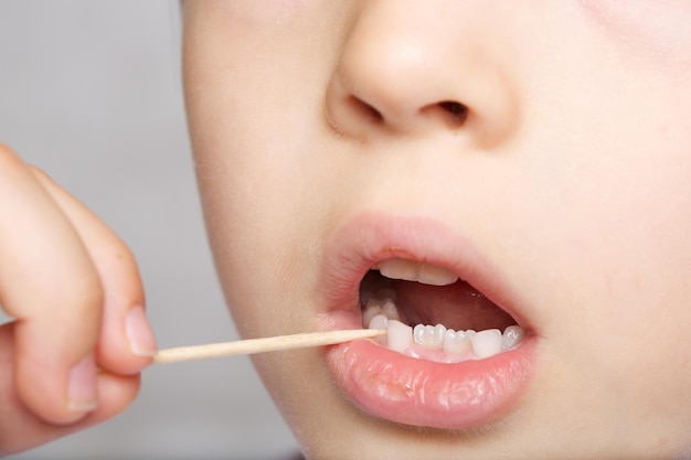 Teeth of six years old child. Closeup