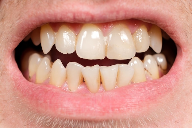 Teeth with tartar and caries crooked lower foreground incisors