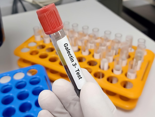 Test Tube with blood sample for Galectin-3 test, diagnosis of cardiovascular disorder.